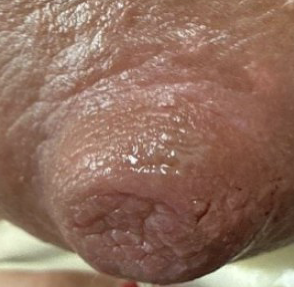 skin tag after removal